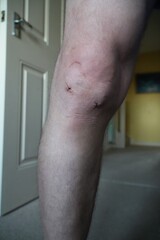 Fototapeta premium Recovery after knee arthroscopy at home