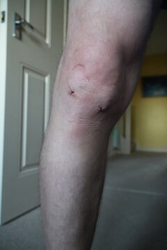 Recovery after knee arthroscopy at home