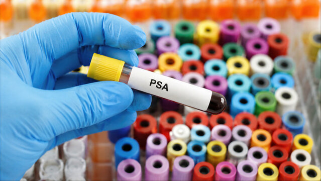 Gloved hand holding a blood sample tube with a PSA label for prostate-specific antigen testing in a clinical laboratory