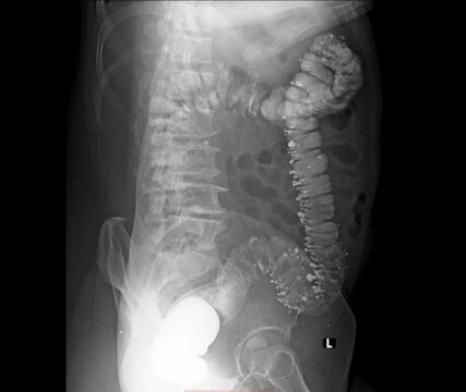 Barium enema X-ray showing multiple diverticula in the colon, diverticulosis.