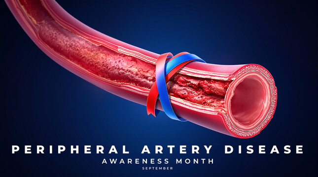 Peripheral Artery Disease Awareness Month Concept Image, featuring vascular health, blood circulation, and artery care.