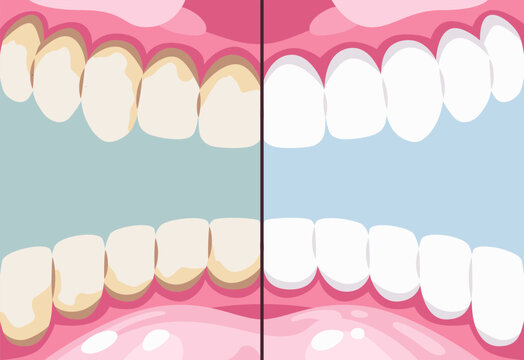 Human jaw with teeth. View from inside. Dental anatomy illustration for oral care and healthcare concepts. Dirty and clean healthy teeth before and after.
