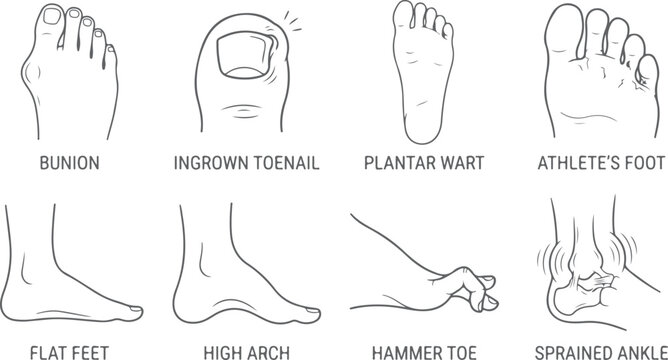Common foot conditions bunion ingrown toenail flat feet hammer toe illustration.