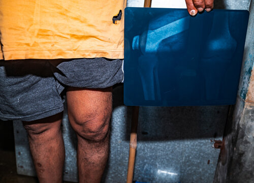 Osteoarthritis is a degenerative joint disease characterized by the wearing down of protective cartilage, causing joint pain and stiffness, and decreased ability to move freely. joint pain, stiffness.