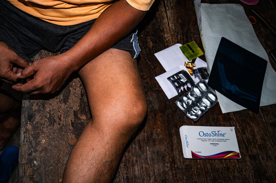 Osteoarthritis is a degenerative joint disease characterized by the wearing down of protective cartilage, causing joint pain and stiffness, and decreased ability to move freely. joint pain, stiffness.