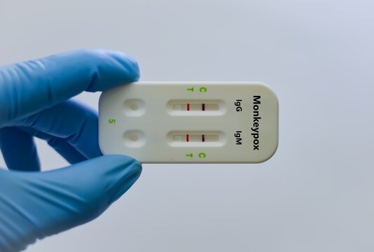 Blood sample of patient positive result for monkeypox virus.