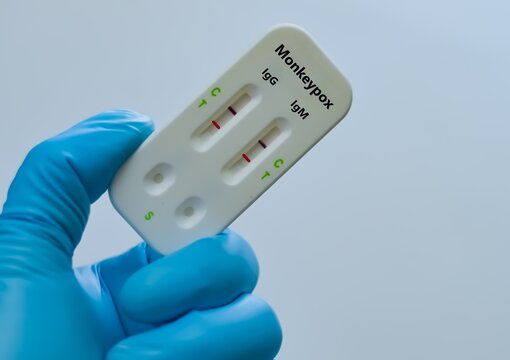 Blood sample of patient positive result for monkeypox virus.