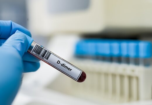 Blood sample tube for D-dimer test analysis.