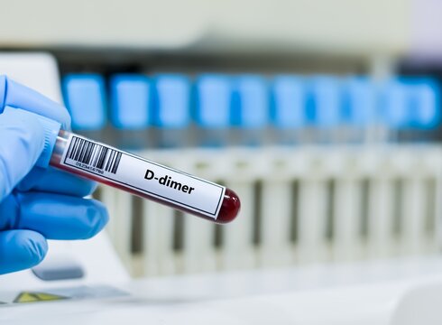 Blood sample tube for D-dimer test analysis.