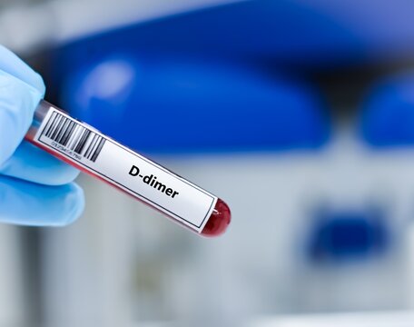 Blood sample tube for D-dimer test analysis.