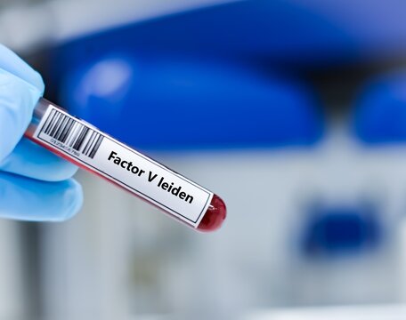 Blood sample tube for factor V leiden test analysis.