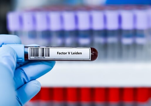 Blood sample tube for factor V leiden test analysis.
