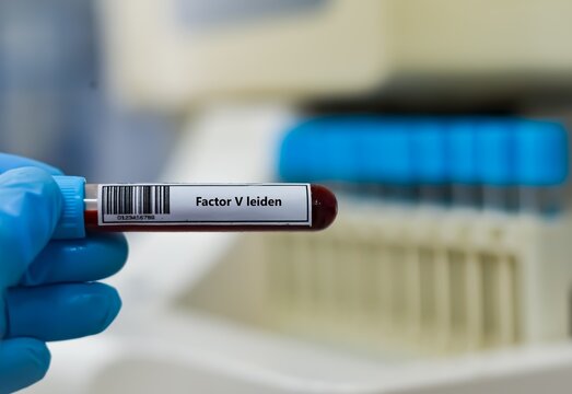 Blood sample tube for factor  V leiden test analysis.