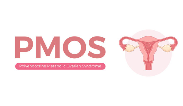 PMOS Polyendocrine Metabolic Ovarian Syndrome Text with Uterine Anatomy Women Health Vector Illustration