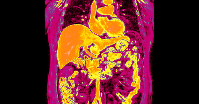 False-color magnetic resonance imaging (MRI) scan of a healthy human upper abdomen in coronal view, highlighting the liver and internal organs. Perfect for medical technology and healthcare concepts.