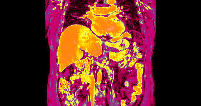 False-color magnetic resonance imaging (MRI) scan of a healthy human upper abdomen in coronal view, highlighting the liver and internal organs. Perfect for medical technology and healthcare concepts.