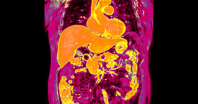 False-color magnetic resonance imaging (MRI) scan of a healthy human upper abdomen in coronal view, highlighting the liver and internal organs. Perfect for medical technology and healthcare concepts.