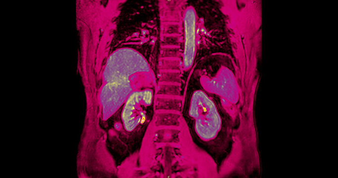 False-color magnetic resonance imaging (MRI) scan of a healthy human upper abdomen in coronal view, highlighting the liver and internal organs. Perfect for medical technology and healthcare concepts.