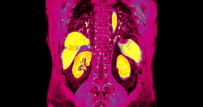 False-color magnetic resonance imaging (MRI) scan of a healthy human upper abdomen in coronal view, highlighting the liver and internal organs. Perfect for medical technology and healthcare concepts.