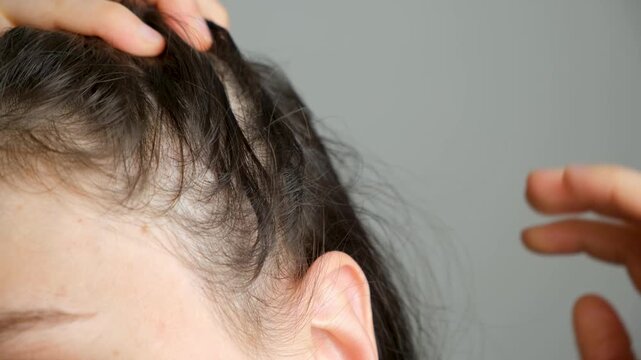 Extreme close up of female scalp showing receding hairline and thinning hair.