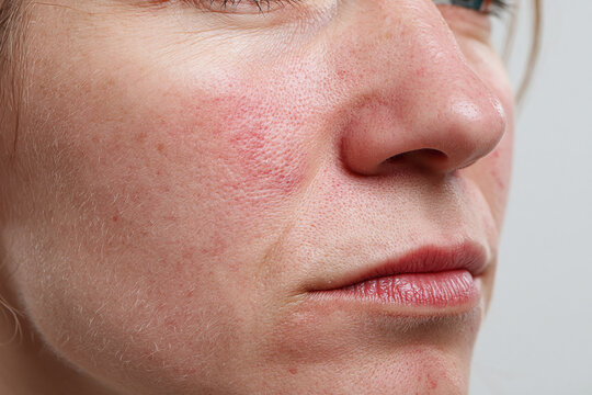 Close up facial redness from irritation and sensitivity showing flushed cheek, visible pores and fine facial hair discomfort
