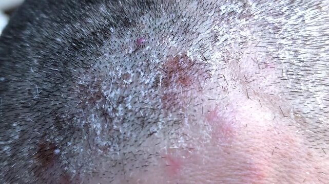 Close-up of male scalp showing visible flakes and dry patches caused by seborrheic dermatitis. inflammation and redness are typical symptoms of common skin condition affecting scalp. seborrhea concept
