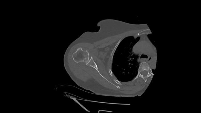 Right Shoulder CT Scan Video Displaying Glenohumeral Joint and Bone Anatomy