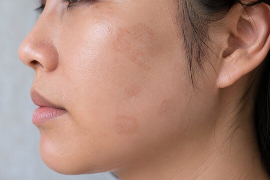 Side View of Ringworm Rash and Circular Fungal Infection on Female Face