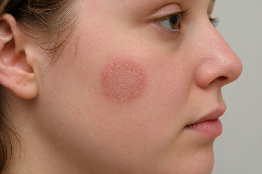 Close Up of Ringworm Rash and Circular Fungal Infection on Female Cheek