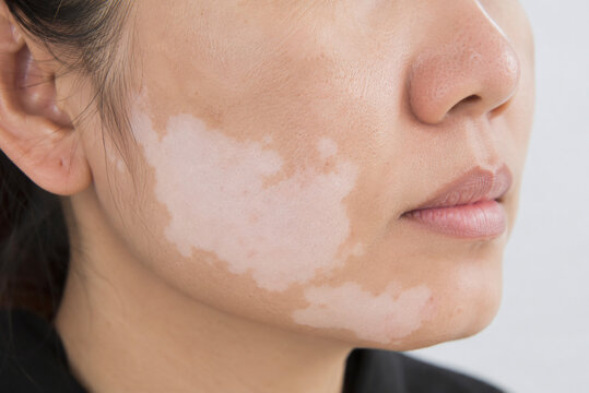 Vitiligo White Patches and Skin Depigmentation on Female Face