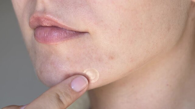 Close-up of woman applying hydrocolloid acne patch on chin. Skincare routine for blemish treatment, pimple care and acne prevention. Natural skin texture, beauty wellness concept, dermatology care.