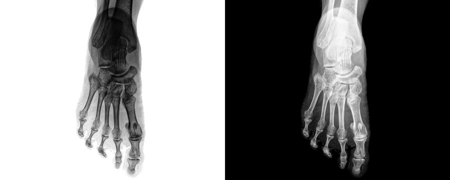 Foot Anterior View X-ray Radiograph Showing Metatarsals Phalanges and Tarsal Bones for Accurate Fracture Diagnosis Isolated on Transparent Background