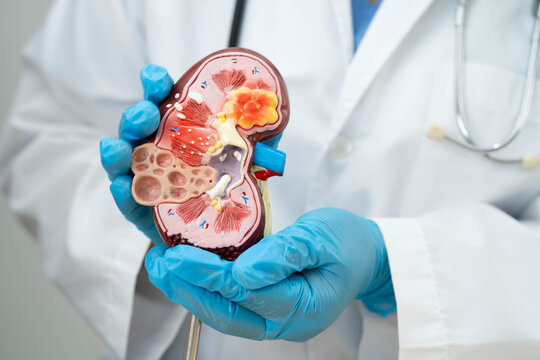 Chronic kidney disease, Asian woman with model for treatment urinary system, urology, Estimated glomerular filtration rate eGFR.