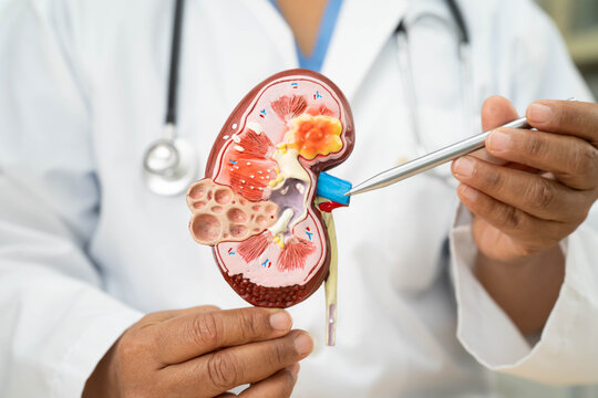 Chronic kidney disease, Asian woman with model for treatment urinary system, urology, Estimated glomerular filtration rate eGFR.