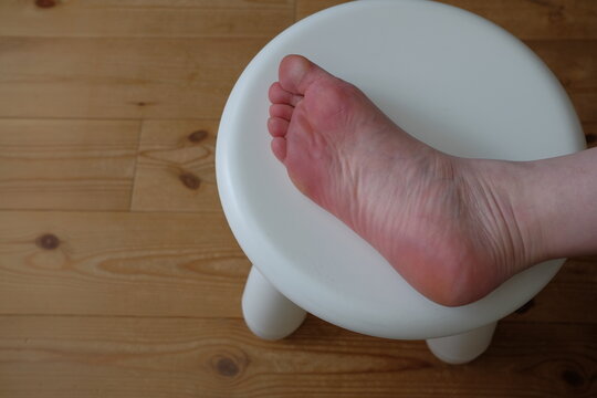 40代女性の水虫になった足