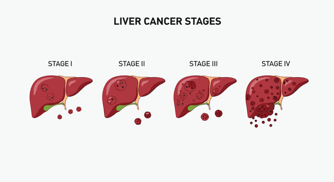 Medical illustration showing the four distinct stages of liver cancer progression from localized tumors to metastatic spread in the body.