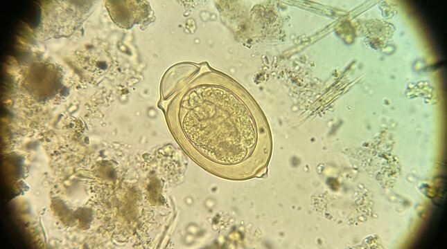 Opisthorchis Viverrini Operculate Egg Shouldered Stool Smear. Opisthorchis viverrini small operculate egg with distinct opercular shoulders and knob in stool wet mount from liver fluke infection.