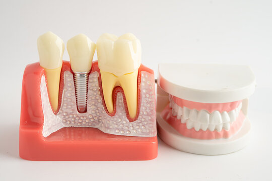 Dental implant, artificial tooth roots into jaw, root canal of dental treatment, gum disease, teeth model for dentist studying about dentistry.