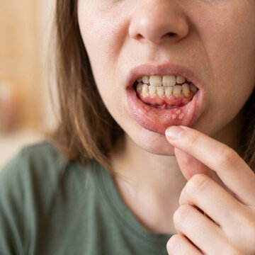 Extreme close-up of a young woman's mouth with stomatitis ulcer, oral health concept focusing on painful canker sores, lip hygiene, and dental disease