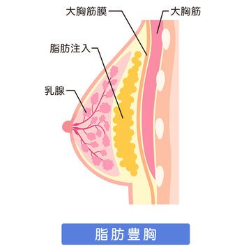 脂肪注入をした胸　豊胸手術の構造　脂肪豊胸