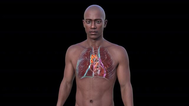 Pulmonary lymphadenitis visualised within transparent thoracic anatomy of adult male body, enlarged inflamed lymph nodes highlighted in rotating 3D medical animation.