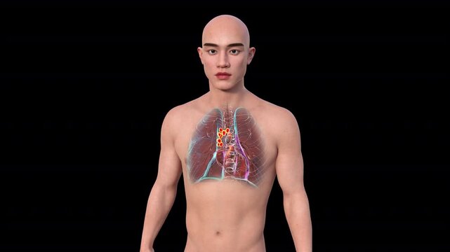 Pulmonary lymphadenitis visualised within transparent thoracic anatomy of adult male body, enlarged inflamed lymph nodes highlighted in rotating 3D medical animation.