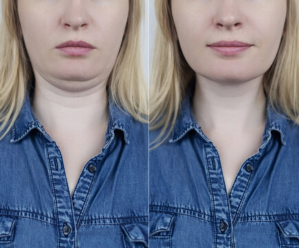 Double chin reduction before and after liposuction. Female neck lift, smas lifting, mentoplasty and genioplasty surgery result. Cosmetic plastic operation transformation.