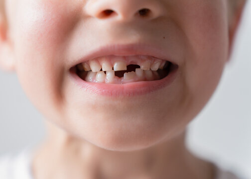 Close up portrait of a smiling child with missing baby tooth. Cute kid showing natural tooth loss during childhood against soft light background. Healthy dental development and growing up concept.