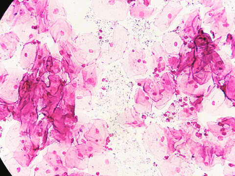 High Vaginal Swab (HVS) for gram stain. Gram positive bacilli seen. Suggestive of lactobacilli.