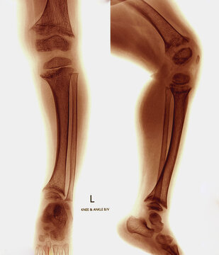 X-ray of human leg. Suggestive of Rickets. 
