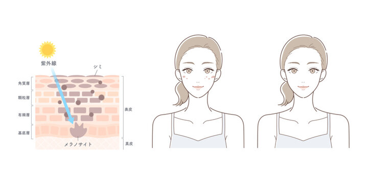 紫外線によるシミ発生の仕組みとメラニン生成の比較イラスト（光老化・肌断面図）