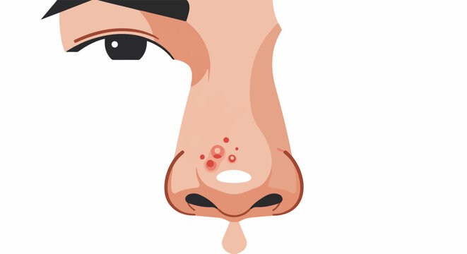 Close-up of a human nose with prominent red blemishes and a drip