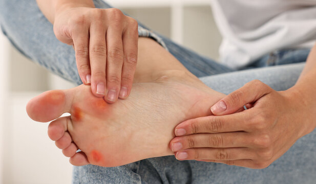 Woman with calluses on her foot at home, closeup