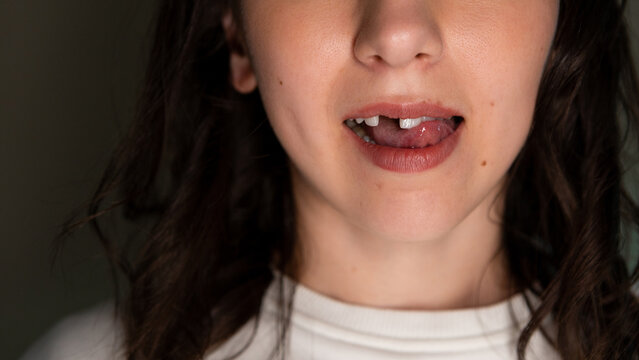 Emotional woman shows her missing tooth while preparing for dental procedure